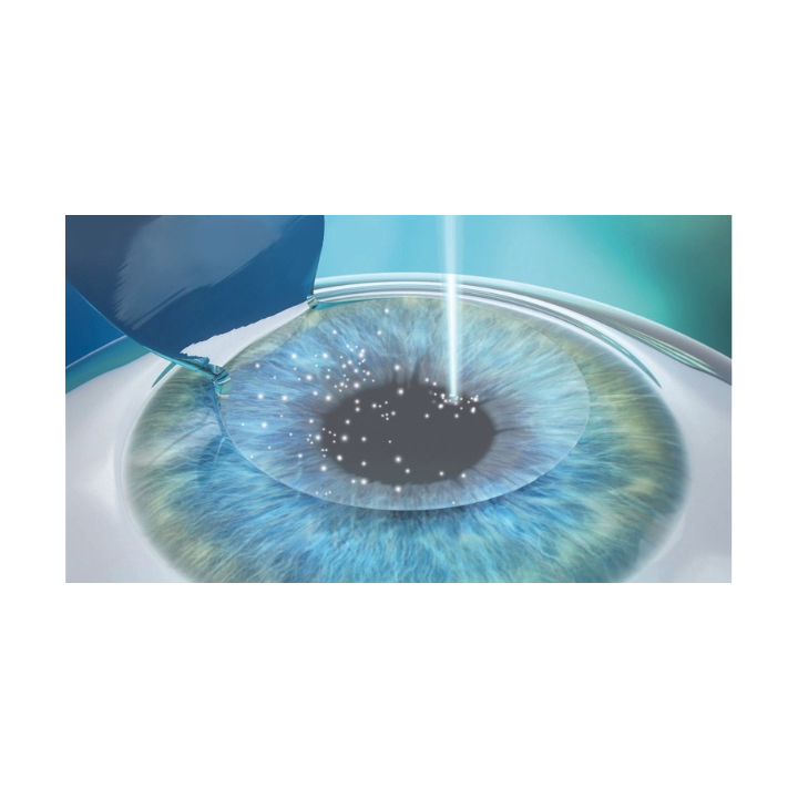 lasik 3
