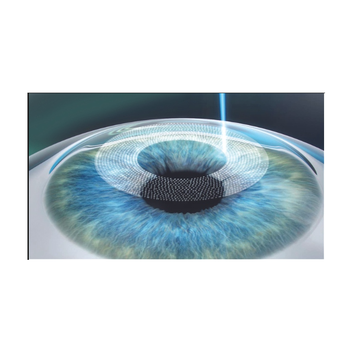 lasik step 1